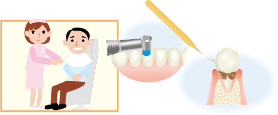 歯周病の治療